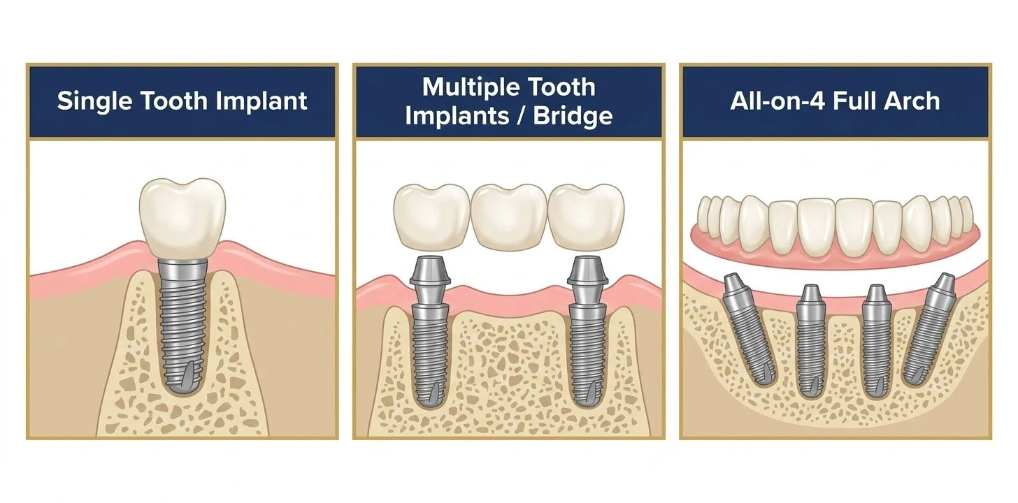 Comparison of dental implant types including single tooth, bridge, and All-on-4 implants